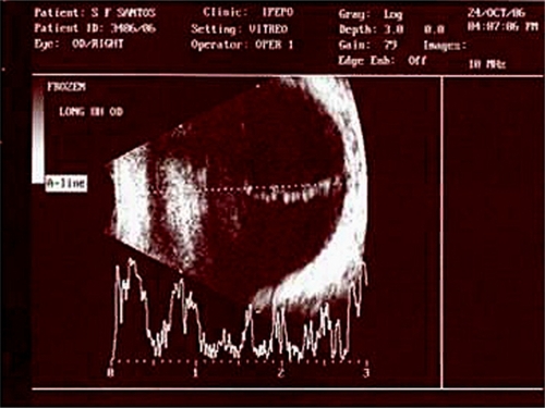 Figure 1 Retinal echography showing vitreous opacities resembling a persistence of fetal vasculature.