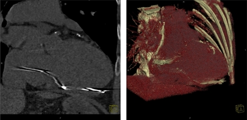 Figure 3 A) Chest computed tomography (CT) shows a perforated ventricular lead tip through the right ventricle and pericardium. B) 3D-recontruction of CT shows a perforated ventricular lead tip through the right ventricle and pericardium.