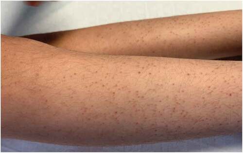 Figure 1. Perifollicular hyperkertotosis and petechiae in the lower limbs