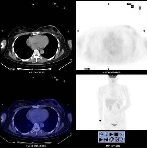 Figure 6 Postoperative PET/CT of the breast.