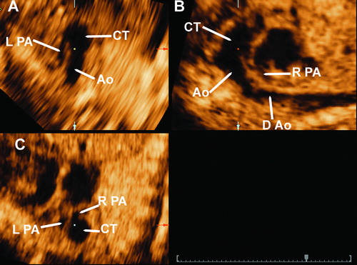 Figure  2.  3D multiplanar display imaging of the common arterial trunk. Panel A: in this transverse plane the left pulmonary artery is seen arising from the common arterial trunk. Panel B: in this sagittal plane the right pulmonary artery and the aortic arch are seen arising from the common arterial trunk. Panel C: coronal view, in which both left and right pulmonary arteries are demonstrated to originate from the common trunk. Ao, aorta; CT, common arterial trunk; RPA, right pulmonary artery; LPA, left pulmonary artery; D Ao, descending aorta.