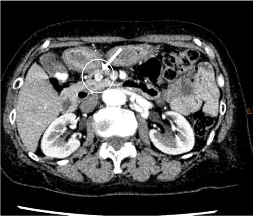 Figure 1 Enhanced CT scan of the upper abdomen.