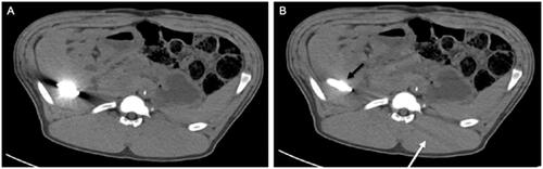 Figure 5. Images of a CRYO ablation probe without iMAR (A) and with iMAR (B). Blooming artifacts along the ablation probe (black arrow) and secondary artifacts in the image periphery detected in iMAR images (white arrow).