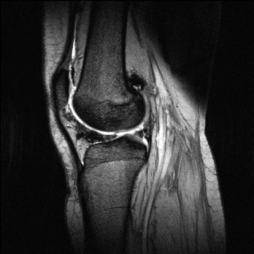 Figure 1. Gradient-echo-based MRI image from a patient with recurrent t-GCT (right knee). There was very low signal intensity corresponding to hemosiderin depositions anterior to the lateral meniscus, extending to the infrapatellar fat pad. Furthermore, there was a hemosiderin deposition in the recessus lateralis posterior to the lateral femoral condyle. These localizations corresponded to recurrent Dt-GCT, which was confirmed by surgical removal.