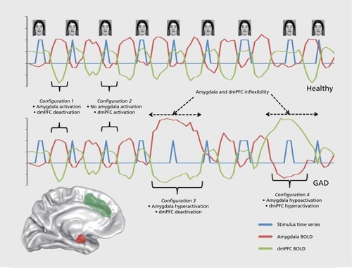Figure 1 Variability of task-induced blood oxygenation—level dependent activity in generalized anxiety disorder: a proposed model. The figure illustrates hypothetical inversely-correlated BOLD signal time courses for the dorsomedial prefrontal cortex (green line), amygdala (red line), and the stimulus (fearful face) during an affective imaging task in healthy controls (graph on top) and individuals with generalized anxiety disorder (graph on bottom). The black brackets indicate periods of the time course that refer to distinct “configurations” of conjoint activity between the dorsomedial prefrontal cortex and amygdala. In healthy individuals, only the first two configurations are represented in the regional time courses. In the individuals with generalized anxiety disorder, however, there are several other distinct configurations of conjoint activity that are represented over the course of the task. Dotted lines indicate periods of the time course that reflect periods of inflexibility, or a failure to change configurations of conjoint brain activity, which may be secondary to brain function being more heavily influenced in individuals with generalized anxiety disorder by stimulus-independent factors. A brain surface is depicted in the lower left hand corner displaying the regions of interest depicted in the hypothetical graphs. BOLD, blood oxygenation level—dependent response; dmPFC, dorsomedial prefrontal cortex; GAD, generalized anxiety disorder.