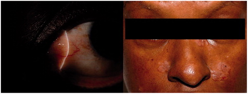 Figure 1. (Left) Slit-lamp appearance of the subconjunctival elevated mass lesion covered with seemingly normal epithelium localized to the medial rectus muscle area in a patient with scleral sarcoid nodule. (Right) Facial appearance of the same patient demonstrating slightly hypopigmented, purplish, indurated, elevated plaques on the left side of her nose and on both cheeks.