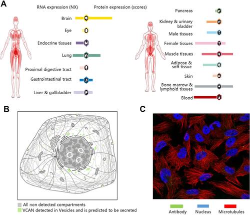 Figure 1 General profile of VCAN gene and protein expressions. (A) VCAN gene and protein expression in human normal organs. (B) The localization of VCAN protein expression in tumor cells. (C) Immunofluorescence staining in U-251 MG cell line.