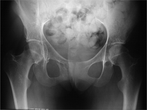Figure 1. Plain radiograph illustrating a classic “simple” fracture of the pubic ramus. Note that the sacro-iliac region appears to be intact.
