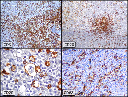 Figure 2. Top left: CD3 immunostain showing numerous T-lymphocytes forming nodules as well as scattered interstitially (Immunoperoxidase × 40, hematoxylin counterstain). Top right: CD20 immunostain demonstrating positivity in collections as well as scattered larger lymphoma cells (Immunoperoxidase × 40, hematoxylin counterstain). Lower left: Membranous positivity of CD20 in the abnormal large lymphoma cells. These cells were best visualized under oil immersion (Immunoperoxidase ×1000, hematoxylin counterstain). Lower right: CD68 immunolabeling reveals marked increase in histiocytes in the background (Immuno-peroxidase ×1000, hematoxylin counterstain).