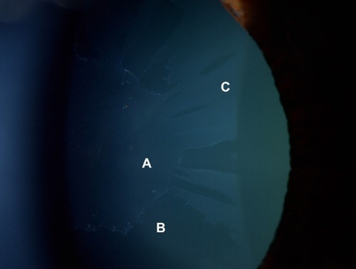 Figure 1 Fully developed (“classic”) pattern of distribution of exfoliation material on the anterior lens capsule.