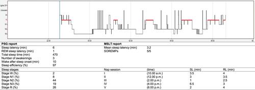 Figure 1 Patient hypnogram, night PSG and MSLT findings at the time of diagnosis.