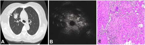 Figure 1 A 50-year-old man had a peripheral pulmonary lesion in the right lung. (A) A round lesion (arrow) could be seen in the right middle lobe with a size of 9 mm×9 mm. (B) Endobronchial ultrasonography revealed a heterogeneous lesion with hyper- and hypoechoic areas. (C) Tumor and normal cells existed in the same area with necrosis and fibrosis in the middle (HE ×100).