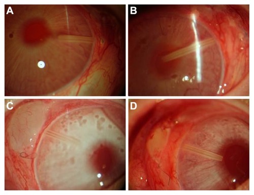 Figure 2 (A–D) Blebs were observed at day 7 after operation under slit-lamp microscope. (A) Control group: blebs disappeared 7 days after operation (16×). (B) Blank/placebo group: blebs disappeared 7 days after operation (16×). (C) MMC group: blebs survived 7 days after operation (16×), less angiogenesis, thinner vessels, lighter color. (D) 5-FU group: blebs shrank, showing the feature of vascular congestion (16×).