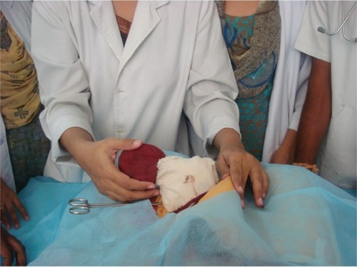 Figure 2 The layers of abdomen and dummy fetus being delivered during the procedure.