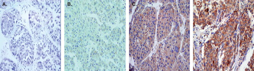 Figure 1. Expression of DcR3 protein in hepatocellular carcinoma tissues. DcR3 protein was detected by immunohistochemistry in hepatocellular carcinoma (HCC) tissues. (A: DcR3 negative; B: positive+; C: ++; D: +++). The signal was localized within the cytoplasm of tumor cells in HCC tissues (×400).