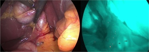 Figure 2 Intra-operative real-time identification of biliary structures with visible light (VL) on left and by fluorescence (NIRF-C) on right.