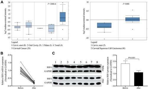 Figure 1 RSF-1 was upregulated in cervical cancer tissues and decreased after effective treatment. (A) The expression of RSF-1 mRNA in cervical cancer tissue and normal control from the ONCOMINE database. (B) The expression of RSF-1 mRNA and (C) RSF-1 protein in 16 pairs of tumor samples from cervical cancer patients before and after radiochemotherapy were examined by qRT-PCR and Western blot.