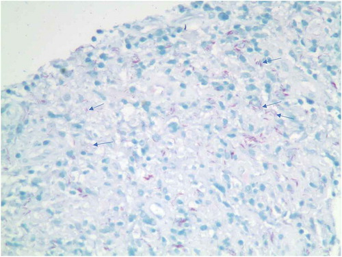 Figure 5. Lymph node biopsy: Many acid-fast bacilli (blue arrows).