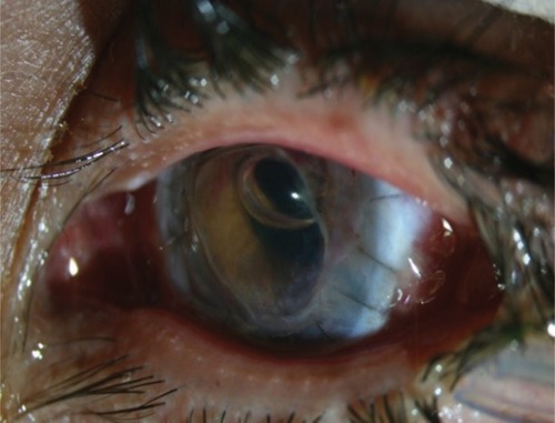 Figure 3 Left eye post penetrating keratoplasty.
