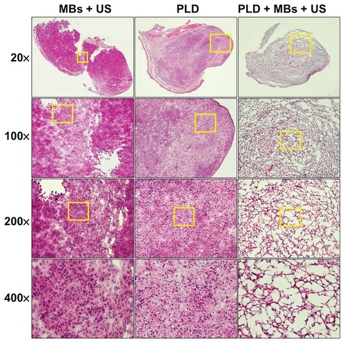 Figure 4 H&E staining of tissue sections for the ear tumors after a sequence of treatments with MBs + US, PLD alone, and PLD + MBs + US.Notes: Magnifications 20×, 100×, 200×, and 400× (yellow square).Abbreviations: H&E, hematoxylin and eosin; MBs, microbubbles; US, ultrasound; PLD, pegylated liposomal doxorubicin.