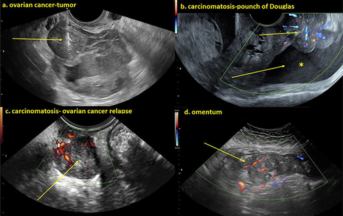 Figure 1 (a) Heterogeneous irregular cystic-solid ovarian tumor and the tru-cut biopsy needle visualized at sampling of the solid component of the lesion. (b) Irregular solid richly vascularized carcinomatosis deposits on peritoneal surface and free fluid *In the pouch of Douglas (c) Heterogeneous solid richly vascularized metastatic tumor relapse in the pouch of Douglas. (d) Irregular solid heterogeneous moderately vascularized omentum metastasis of ovarian cancer.