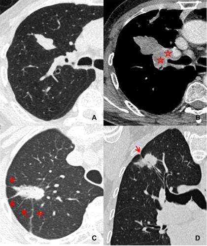 Figure 2 Differentiation between peripheral small-cell lung cancer (pSCLC) and peripheral non-small cell lung cancer (pNSCLC). Axial computed tomography (CT) image in a 76 year old male with pSCLC shows an irregular nodule with homogeneous density and smooth margin (A), 99 days later, the nodule size increases obviously and the right hilar lymphadenectasis is detected simultaneously (red stars) on contrast enhanced CT image (B). Axial and reconstructed CT images in a 73 year old female with pNSCLC show an oval nodule with heterogeneous density, spiculation (red arrows) (C), and pleural indentation (red arrow) (D).