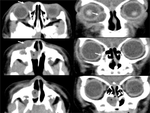 Figure 2 Computed tomography scan images showing the dacryocystocele (arrows) in patient 1. The dacryocystocele formed consecutive nasal cysts (asterisks), which occluded the left inferior nasal meatus.
