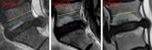 Figure 2 Grade A, B, and C of MC II on T2-weighted sagittal MRI. The blue dashed line represents 25% of the vertebral height; the yellow dashed line represents 50% of the vertebral height.