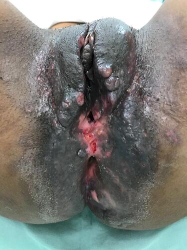 Figure 2 Abscess in the region of the large left vulvar lip and perianal fistulas, consistent with perianal Crohn´s disease.