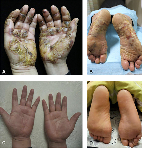 Figure 1 Clinical improvement of patients after 6 weeks of dupilumab treatment. (A and B) at baseline; (C and D) after 6 weeks of treatment.