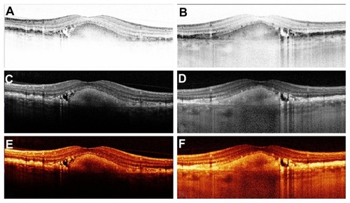 Figure 1 Vertical cross-sectional scan of the left eye through the fovea of a 66-year-old female patient displaying a central fibrovascular pigment epithelial detachment. The display modalities are black/white mode in (A) (conventional) and (B) (enhanced depth imaging); white/black mode in (C) (conventional) and (D) (enhanced depth imaging); and color/heat mode in (E) (conventional) and (F) (enhanced depth imaging). Inverted scans (B, D, and F) show an increased imaging depth of the choroid in all three different display modalities, compared to the conventional scans.