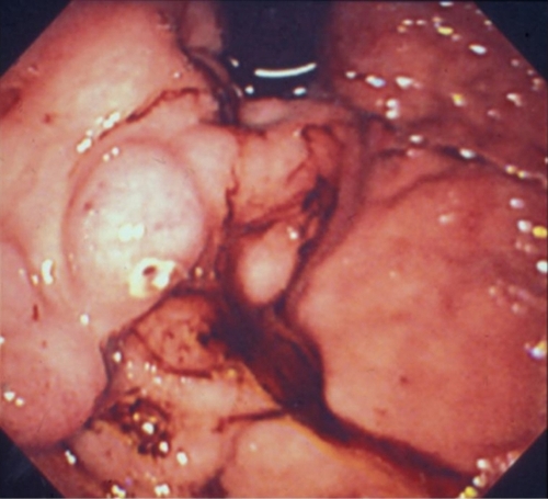 Figure 1a Image of a white plug observed on gastric varices during emergency endoscopic examination.
