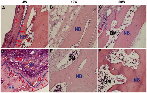 Figure 7. H&E staining of cranial bone defect sections in the control group (A–C) and in the PECE/Collagen/n-HA hydrogel composite treatment group (D–F). The treatment group had no significant foreign body reaction and inflammatory action. Two groups permitted bone ingrowth, but the treatment group demonstrated more rapid and successful osteogenesis at the defect site than that of the control group. The following abbreviations are used: BM: bone marrow; HB: host bone; IM: implanted material; NB: new bone; VT: vascular tissue; O: osteoid. The red (arrows) represent the new osteoid that formed at the HB edge. The blue (dotted line) denotes the junction of the HB with the defect site (Fu et al., Citation2012).