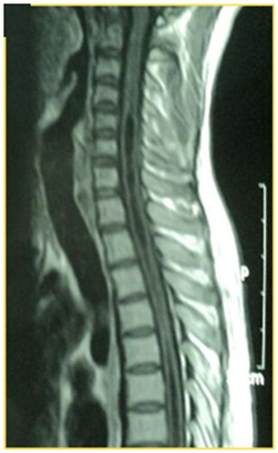Figure 3. A T1W MRI image, sagittal view of the cervical spine, of a 28-year-old male involved in MVA that resulted in the fracture of D6, ASIA A, no surgical intervention. After 2 years, follow-up MRI showed syringomyelia that extended to the cervical spinal cord.
