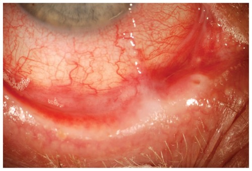 Figure 1 Initial slit lamp photograph showing subconjunctival fibrosis, symblepharon, and forniceal foreshortening.