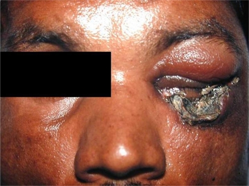 Figure 3 Black eschar involving the left lower lid with residual edema of the left upper lid.