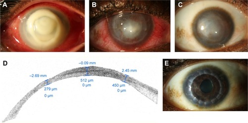 Figure 1 Slit lamp photograph of the right eye of 35-year-old contact lens wearer with Pseudomonas keratitis.