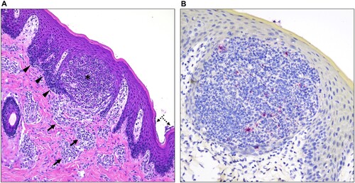 Figure 2. Histological alterations in the skin and immunohistochemical detection of MPXV antigen in one of the infected pigs. (A) Histologic alterations are characterized by epidermal pustule formation (*), hyperplasia of the adjacent epidermis (arrowheads) and superficial perivascular lymphohistiocytic and eosinophilic dermatitis (arrows). The corneal layer of the epidermis was occasionally colonized by coccoid bacteria (dashed arrows). (B) Within this single pustule, sporadic degenerate inflammatory cells contain minimal intracytoplasmic viral antigen (red). No viral antigen was detected within keratinocytes or other cell types. H&E, 200X total magnification; Fast Red, 400X total magnification.
