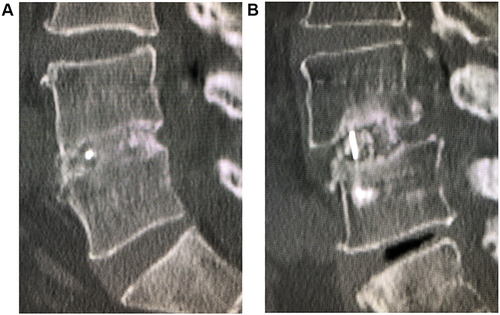 Figure 4 The status of graft bone union was evaluated using X-ray computed tomography. An independent radiologist without knowledge about the patients evaluated graft bone union. Graft bone union was evaluated by the continuity of the bone trabeculae between upper and lower vertebral body through a graft bone. (A) shows the presence of union. (B) shows the absence of union.