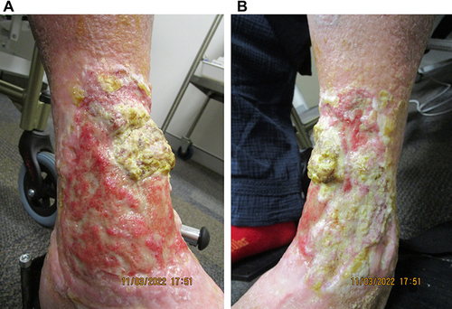 Figure 6 Further improvement at week 82 of tildrakizumab treatment on the (A) anteromedial and (B) anterolateral aspects of the left leg. Although focal areas of impetiginization are prominent, there is obvious significant further re-epithelialization.