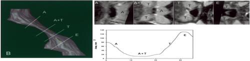 Figure S5 Left: three-dimensional display of an upper airway and its centerline in a subject with OSAS. Top right: gray-level two-dimansional scene of the cross-section of the airway orthogonal to the centerline at marker locations: A = adenoid; A + T = adenoid and tonsil overlap; T = tonsils; E = epiglottis. Bottom right: plot of the cross-sectional area function.Note: Reprinted with permission of the American Thoracic Society. Copyright © 2020 American Thoracic Society. Arens R, McDonough JM, Corbin AM, Rubin NK, Carroll ME, Pack AI, et al. 2003. Upper airway size analysis by magnetic resonance imaging of children with obstructive sleep apnea syndrome. Am J Respir Crit Care Med. 167. 65–70. Official journal of the American Thoracic Society.Citation48