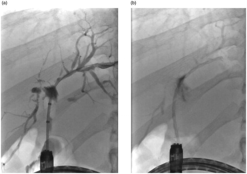 Figure 8. The fluoroscopy views of patient (number 5) with left site intrahepatic stricture (a) before and (b) after stenting with Archimedes stent.