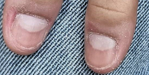 Figure 5 At the ten-month follow-up after completing four PDL treatments, the previously dystrophic thumbnails had been entirely resolved and did not reappear.