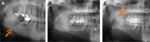 Figure 3 Panoramic dental X-ray showing right mandibular osteomyelitis (“lumpy jaw syndrome”).Notes: An unfavorable outcome resulted, despite dental extraction of tooth 46 (with arrow showing mandibular thickening with lucencies) (A), followed by tooth 45 2 months later (B). Surgical debridement and decortication were required due to extension of the osteomyelitis to the gonial angle and to the ramus (with arrow showing the typical radiologic aspect of lumpy jaw syndrome) (C).