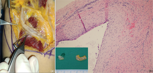 Figure 2. Intraoperative findings and histological confirmation. (a) the common peroneal nerve runs around the fibular head, and a longitudinal and lobulated mass (arrowhead) is observed inside the nerve sheath. (b) Pathological examination reveals a cystic structure containing mucinous or gelatinous fluid and lined by flattened or cuboidal cells, confirming the diagnosis as a ganglion cyst. (hematoxylin and eosin stain, ×100).