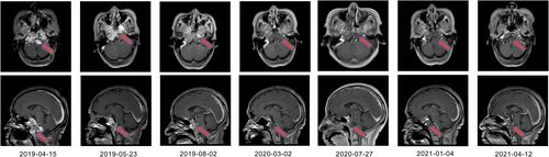 Figure 1 Representative magnetic resonance imaging (MRI) scans. MRI images taken during radiotherapy, at the end of radiotherapy, after 2 cycles of immunotherapy, after 7 cycles of immunotherapy, after 12 cycles of immunotherapy, after 16 cycles of immunotherapy, and during follow-up were shown respectively.