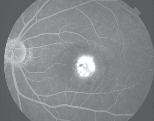 Figure 3c Late phase fluorescein angiogram with late leakage of the choroidal neovascularization (predominantly classic type).