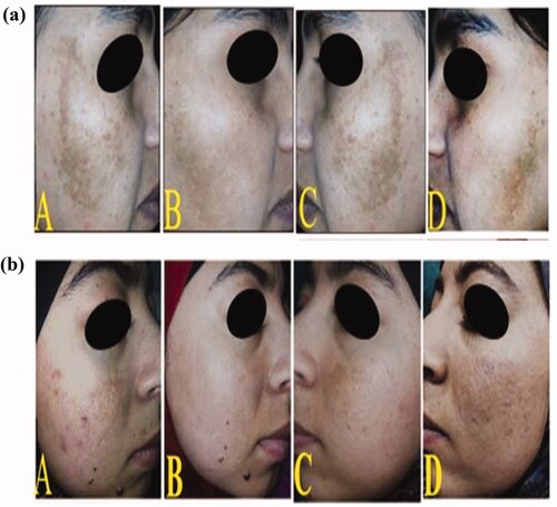 Figure 5. Two female patients with epidermal melasma: (A and C) photos for both sides of the face; right and lift, respectively before treatment showing brown spotty patches along the malar region, (B) the right side of the face after 2 months of treatment showing mild improvement in group I after topical application of C5 hydrogel (a) and good improvement in group II after topical application of C8 hydrogel (b), (D) the left side of the face after 2 months of treatment showing no improvement in both females after topical application of α-arbutin hydrogel.