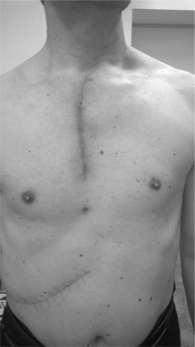 Figure 4 Skin scar 3 months after the operation.