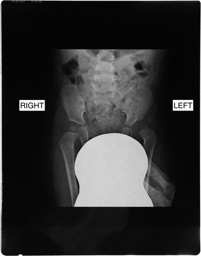 Figure 2. X-Ray examination at 1 year and 6 months of age, showing hypoplasic left femoral cephalic nucleus (arrow).